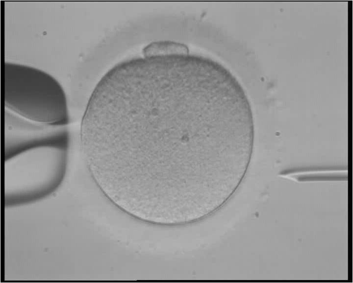 in vitro fertilization 